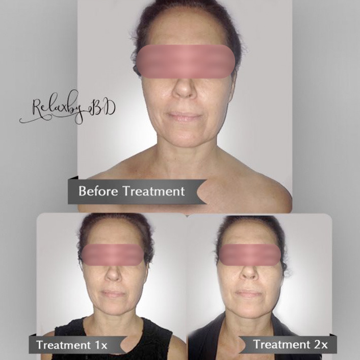 Exilis Elite for Face Relax Bridestory Exilis Elite for Face Relax Bridestory
